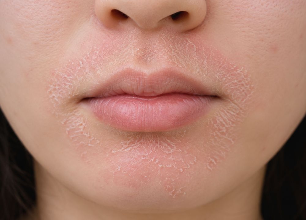 How to Get Rid of Dry Skin Around the Mouth Overnight? Close-up of a person's lower face showing dry, flaky skin around the mouth and chin, suggesting dehydration or a skin condition. Tone is neutral.