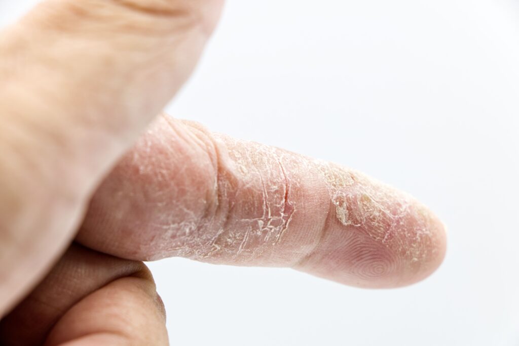 What is the Best Hand Lotion for Dry Cracked Hands Detailed close-up of a human finger with dry and calloused skin showcasing texture and skin condition.