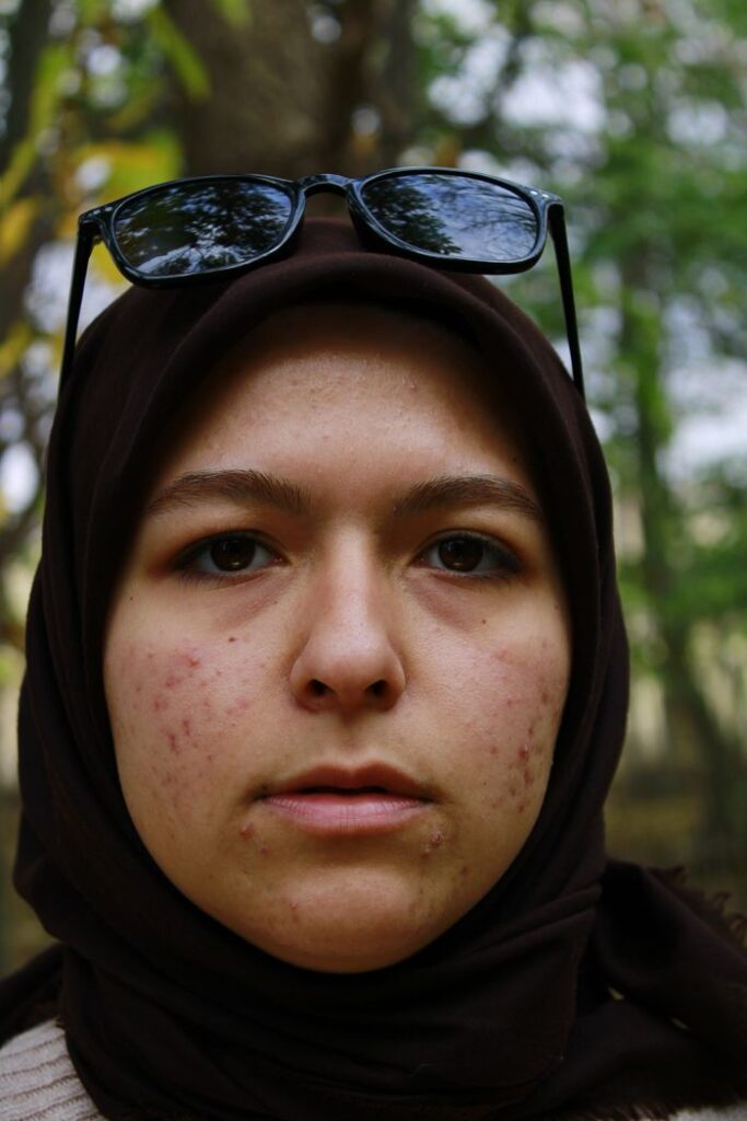How to Get Rid of Redness from Acne: Fast and Lasting Ways Close-up portrait of a woman in a headscarf wearing sunglasses, set against a natural background.