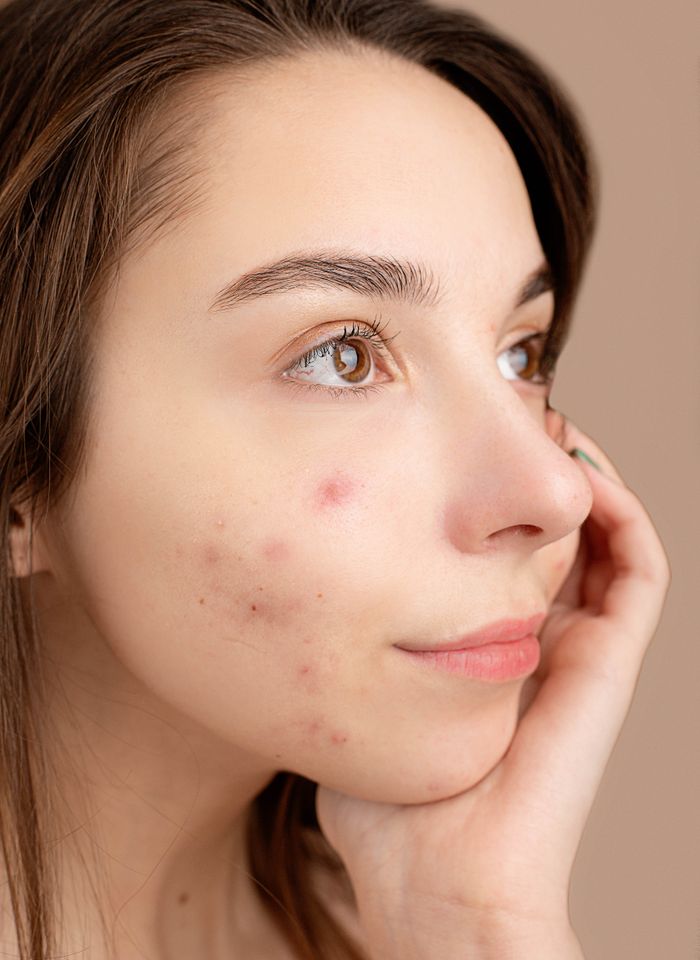 Close-up portrait of a young woman with acne, hand on face, pensive expression.