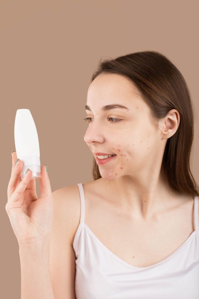 How to Get Rid of Redness from Acne: Fast and Lasting Ways Smiling woman with acne holds a skincare product, highlighting facial care and treatment.