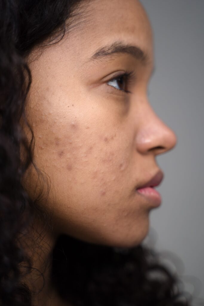 Does Oil Cleansing Help With Blackheads? Close-up side profile of a woman showing natural skin with acne.