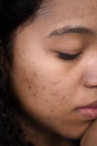 Best Skincare Routine for Acne-Prone Skin Extreme close-up of a woman's face showing skin imperfections and calm expression.
