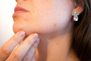 Can Vitamin C Serum Cause Acne? acne, pores, skin, pimple, female, face, skincare, infection, treatment, disease, dermatology, facial, person, hygiene, painful, scar, irritation, young, bacteria, pus, caucasian, eruption, sebaceous, blackhead, complexion, hormone, girl, woman, lady, party killer, crisis, emergency, blemish, problems, cheek, sore, cosmetic, adult, spots, products, health, care, problematic, killjoy, inconvenient, timing, party, hacks, chick, epidermis, help, zit, bothersome, annoying, outbreak, makeup, non-comedogenic, foundation, color, tone, undertone, medical, puberty, acne, acne, acne, acne, acne, pimple